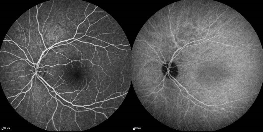 Angiographie Numérisée