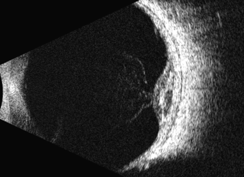 Écographie B - Échobiométrie Optique