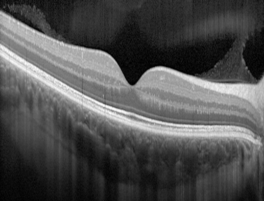 Optical Coherence Tomography (O.C.T)