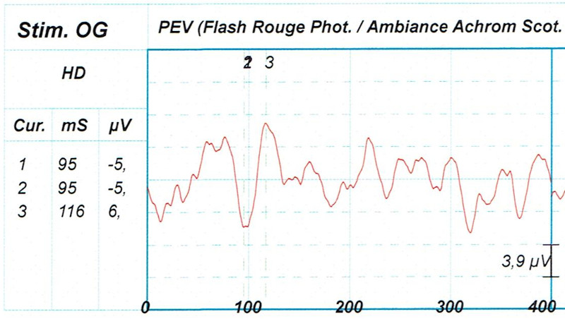 Potentiels Évoqués Visuels (P.E.V)